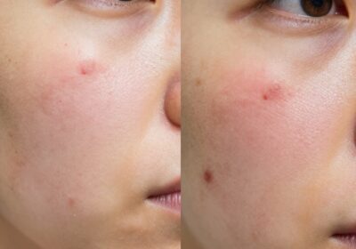 Fungal Acne vs Acne: How to Tell Them Apart