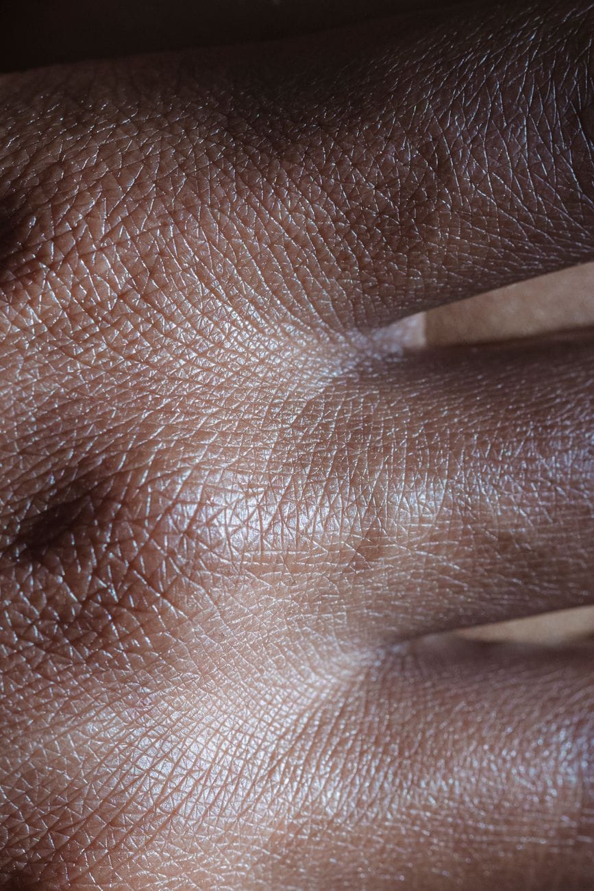 Close-up of skin texture, illustrating why fungal acne vs acne is hard to judge by eye